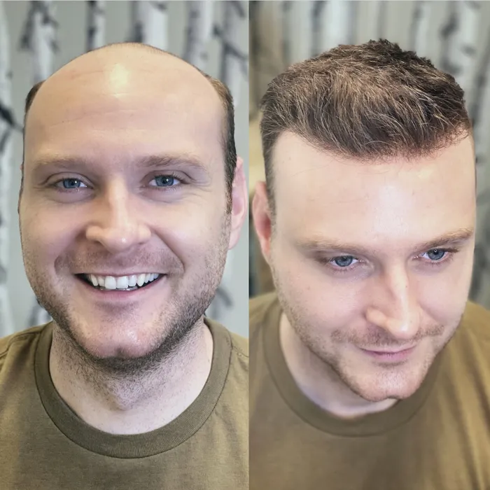 Client before and after, receding hairline restored