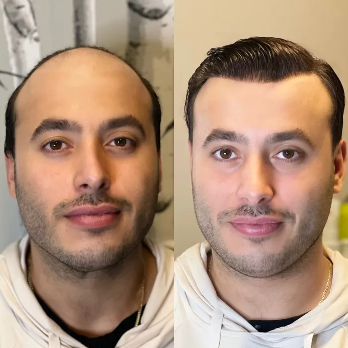 Client before and after, full crown coverage