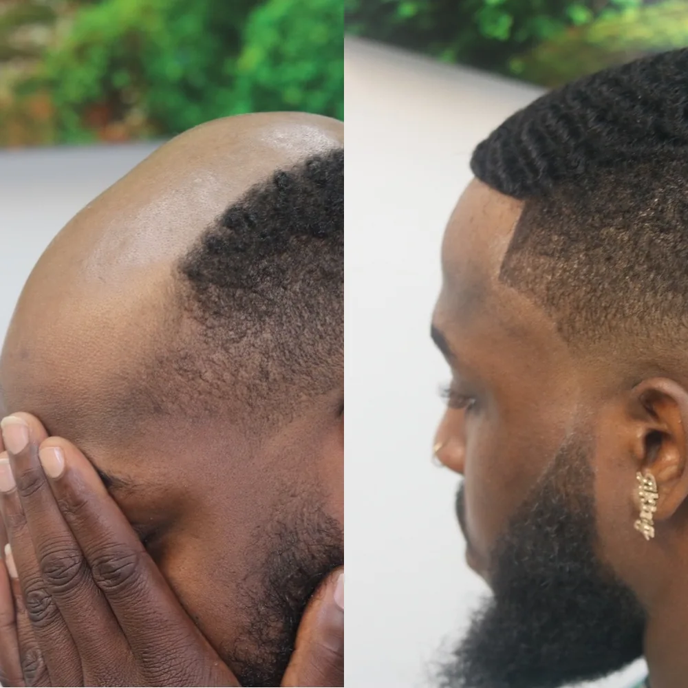 Client before and after, bald front replaced with a waved hair unit and sharp line-up