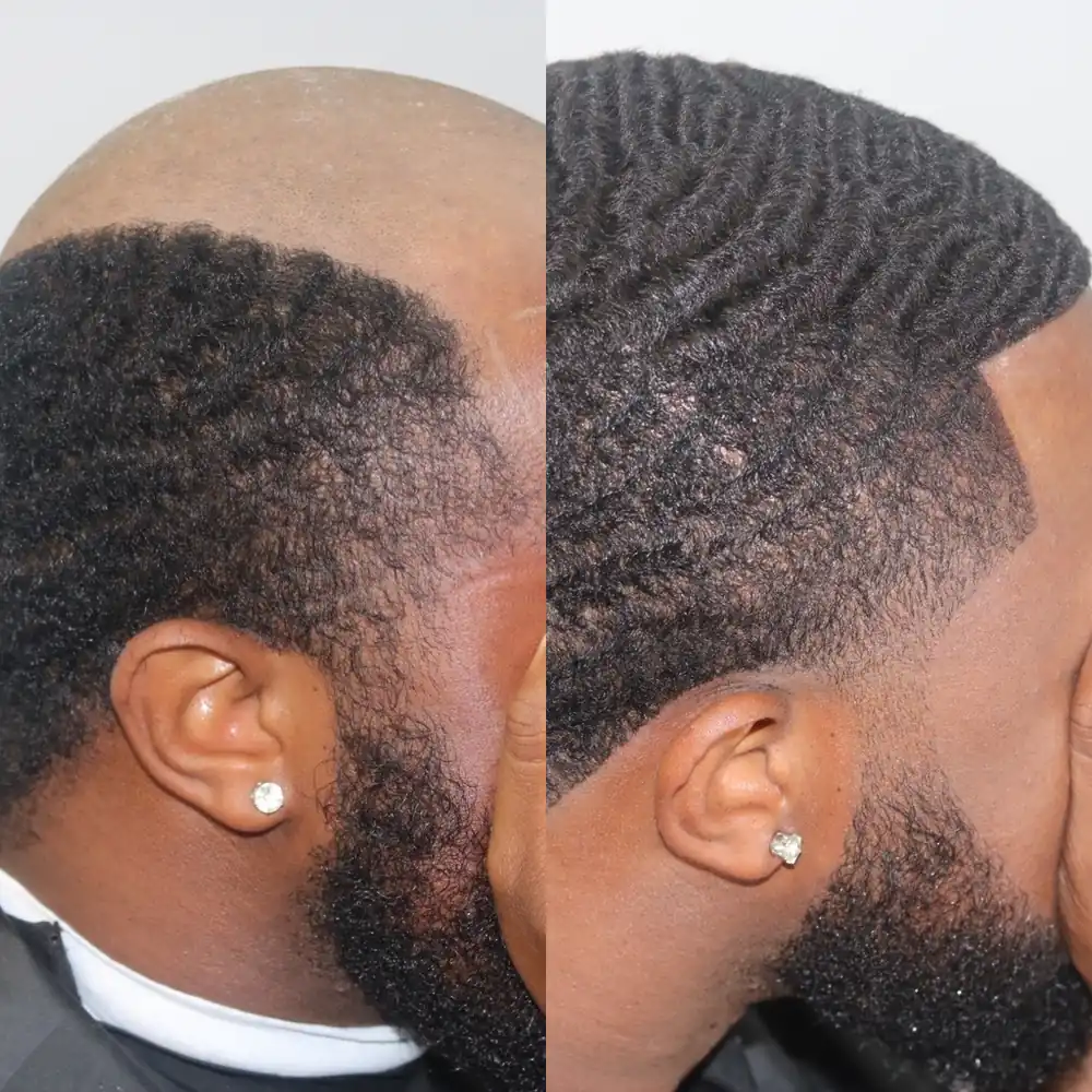 Client before and after, thinning top replaced with a 360 wave hair unit