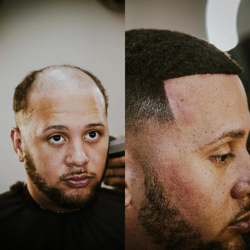 Kristof before and after, from scalp micropigmentation to his first hair unit